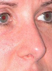 Revision Rhinoplasty - Patient 2 - Obl Right - After Revision Rhinoplasty - Patient 2 - Obl Right - After